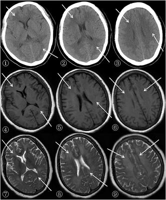 Delayed Post-Hypoxic Leukoencephalopathy Following Nitrite Poisoning: A Case Report and Review of the Literature